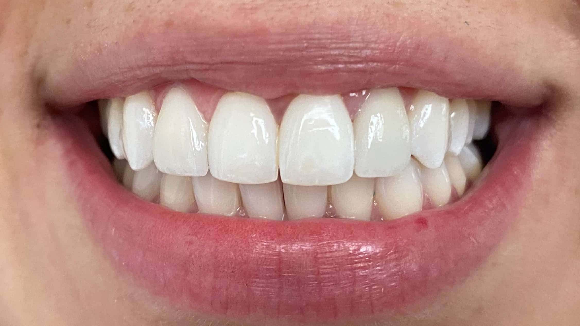 despues_carillas Precio de Limpieza Dental en Guatemala: Obtén una Sonrisa Radiante y Saludable