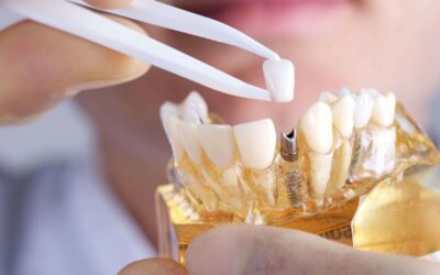 Implantes Dentales