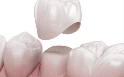 ¿Cuánto tiempo(años) duran las coronas dentales?