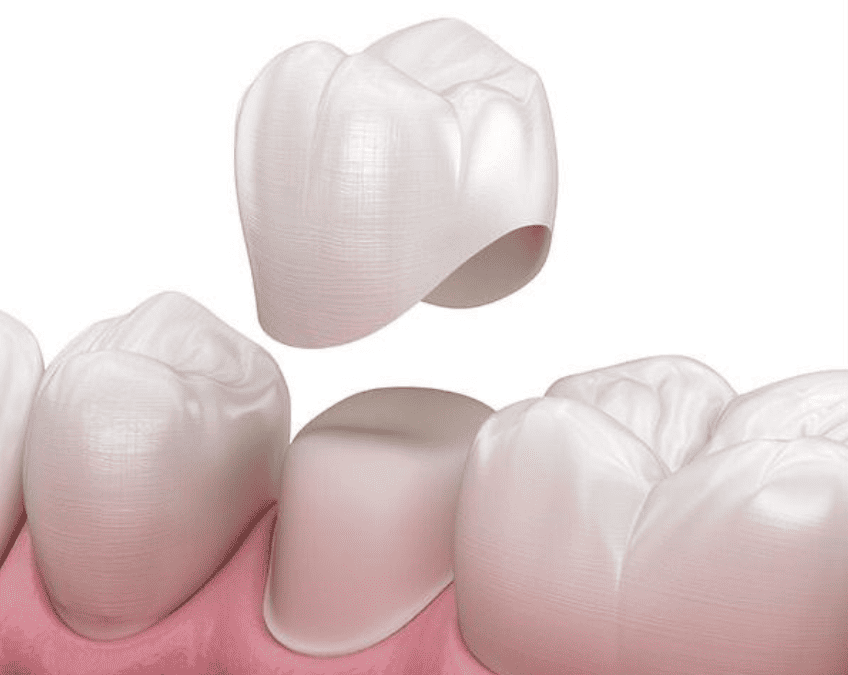 ¿Cuánto tiempo(años) duran las coronas dentales?