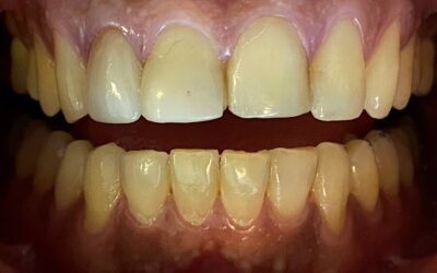 ¿Cuáles son las coronas dentales más estéticas?