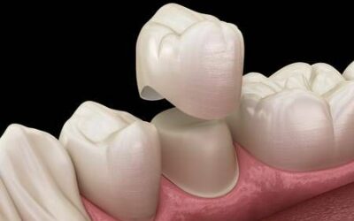 ¿Cuánto tiempo duran las coronas dentales de acrílico?