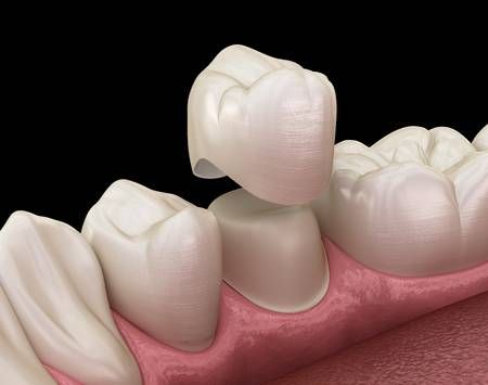 ¿Cuánto tiempo duran las coronas dentales de acrílico?