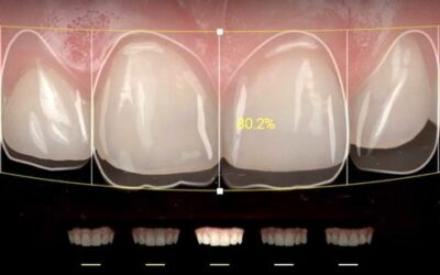 ¿Qué es un diseño digital de sonrisa?