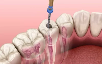 ¿ Qué es una endodoncia?(TRATAMIENTO DE CANALES)