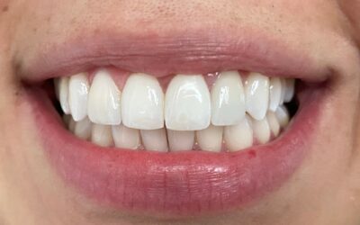 ¿Qué es el blanqueamiento Dental?