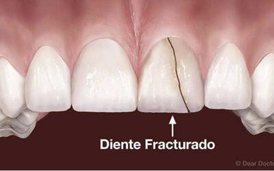 ¿Cuando ya no se puede realizar una endodoncia?