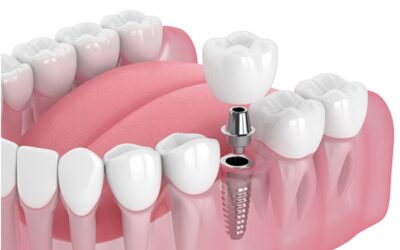 ¿Cuál es el costo de un implante dental?