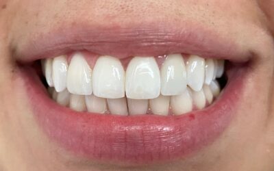 What are Dental Veneers?