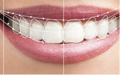 What is a digital smile design?