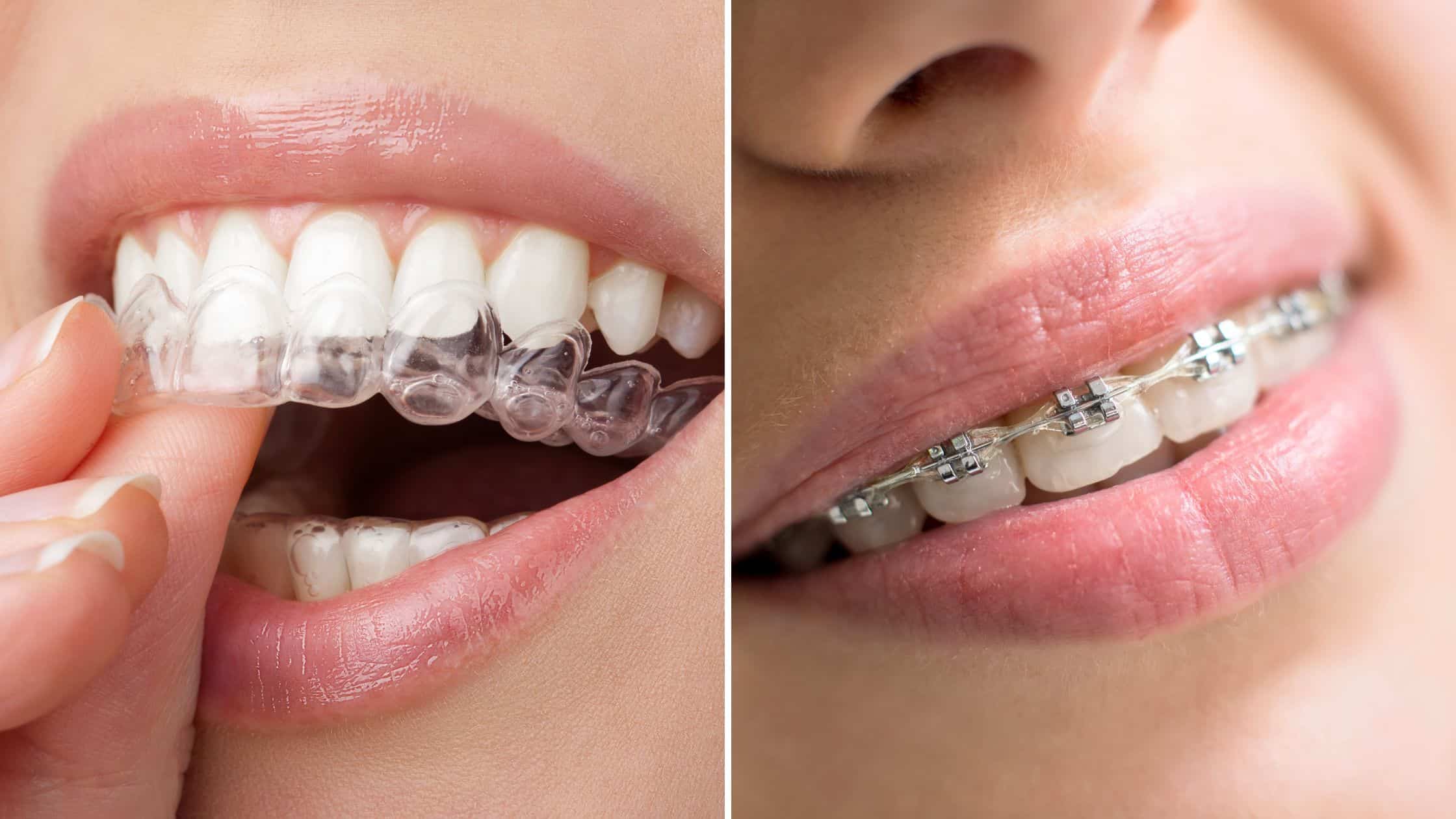 alineadores invisibles vs brackets alineadores invisibles vs brackets