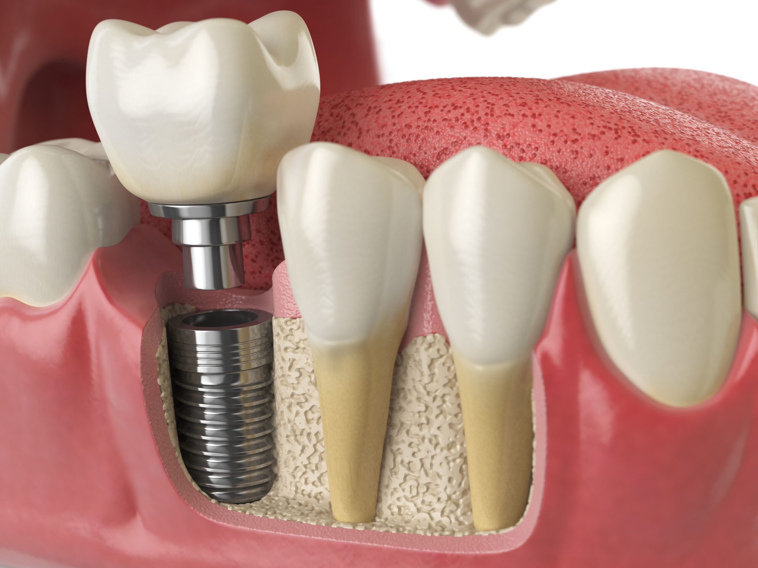 ¿Qué alimentos puedo consumir después de los implantes dentales?