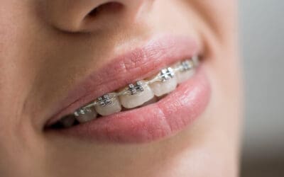 Ortodoncia con Brackets en Guatemala 2025: Guía de Precios y Todo lo que Necesitas Saber