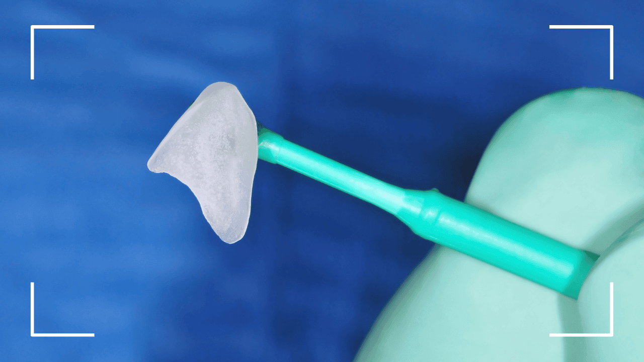 Cómo limpiar las carillas dentales: cuidado y mantenimiento