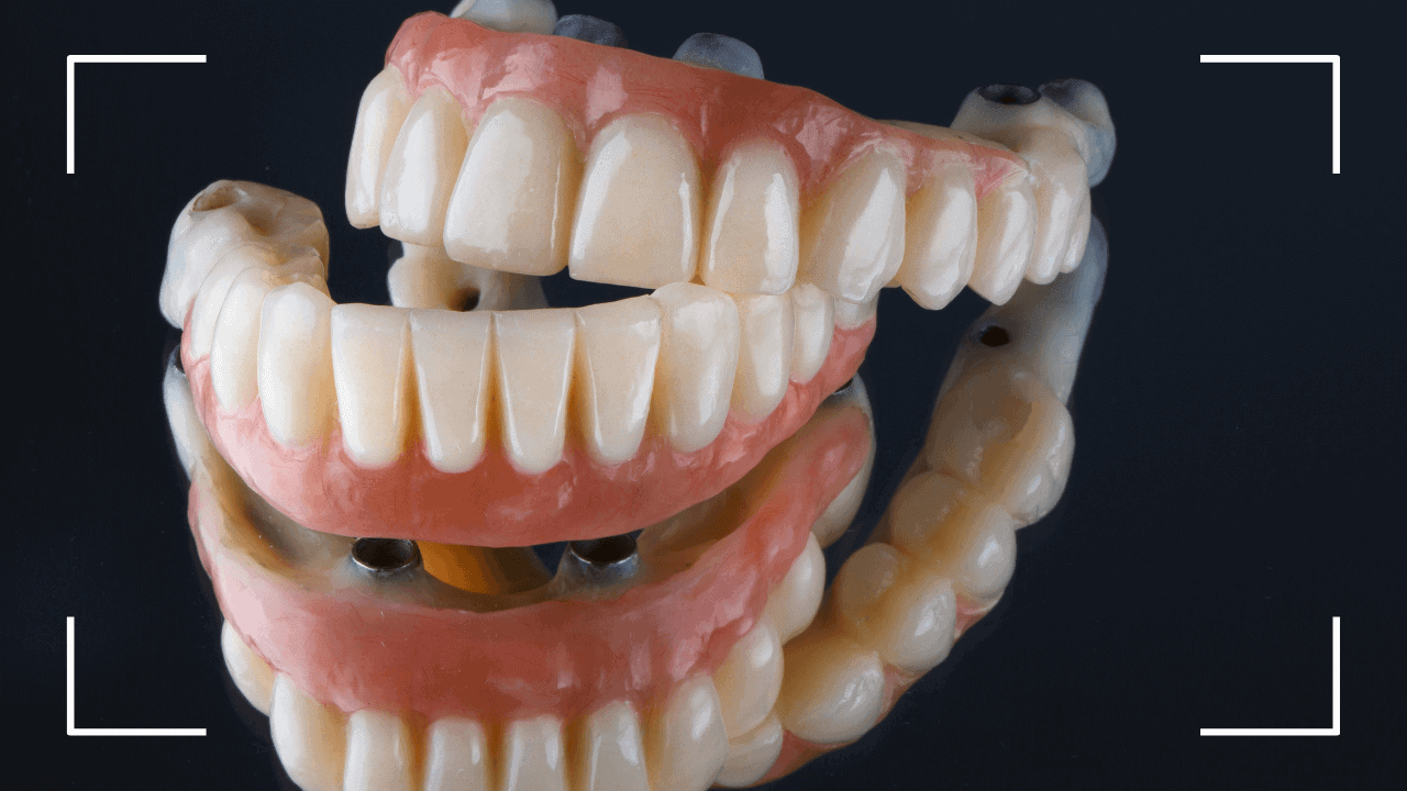 Prótesis dentales ¿Fijas o removibles (1) Prótesis dentales: ¿Fijas o removibles?