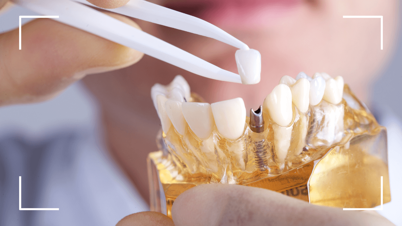 ¿Cuánto duran los implantes dentales según su tipo de material (1) ¿Cuánto duran los implantes dentales según su tipo de material?