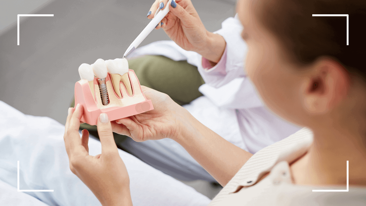 ¿Qué comer después de un implante dental? Una guía completa