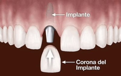 Dental Implants in Guatemala: A Permanent Solution for a Confident Smile