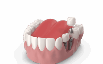 Understanding the Types of Dental Implants Offered at iSmile Guatemala