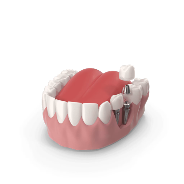 Understanding the Types of Dental Implants Offered at iSmile Guatemala
