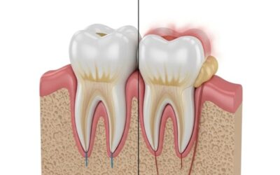 Gingivitis y Periodontitis en Guatemala: Guía Completa para Proteger tus Encías en iSmile