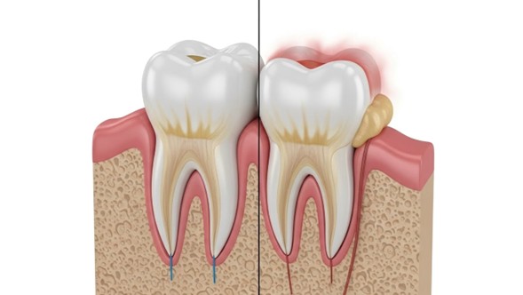 Imagen1 Gingivitis y Periodontitis en Guatemala: Guía Completa para Proteger tus Encías en iSmile